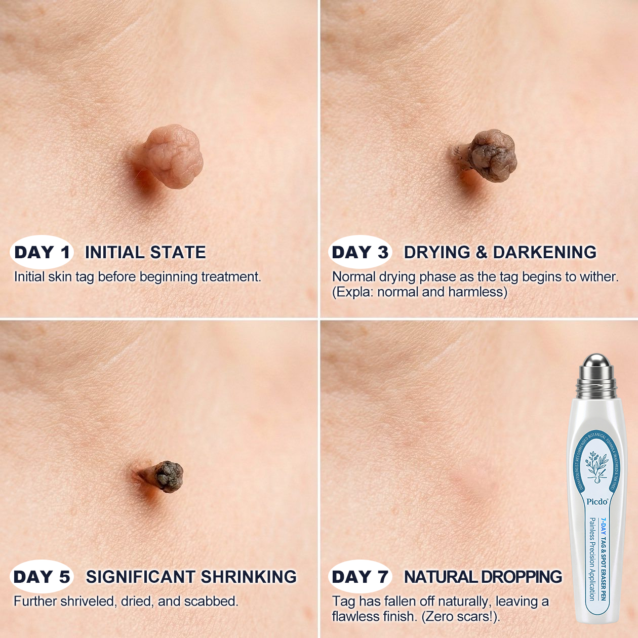 🥝𝟕-𝐃𝒂𝐲 𝐒𝒌𝐢𝐧 𝐓𝒂𝐠 & 𝐒𝐩𝒐𝐭 𝐄𝐫𝒂𝐬𝒆𝐫 - Painless & Scar-Free Advanced Imperfection Remova𝗜 Ro𝗜𝗜erba𝗜𝗜 Pen
