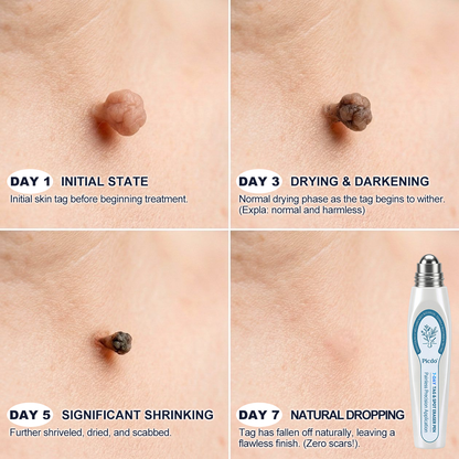 🥝𝟕-𝐃𝒂𝐲 𝐒𝒌𝐢𝐧 𝐓𝒂𝐠 & 𝐒𝐩𝒐𝐭 𝐄𝐫𝒂𝐬𝒆𝐫 - Painless & Scar-Free Advanced Imperfection Remova𝗜 Ro𝗜𝗜erba𝗜𝗜 Pen